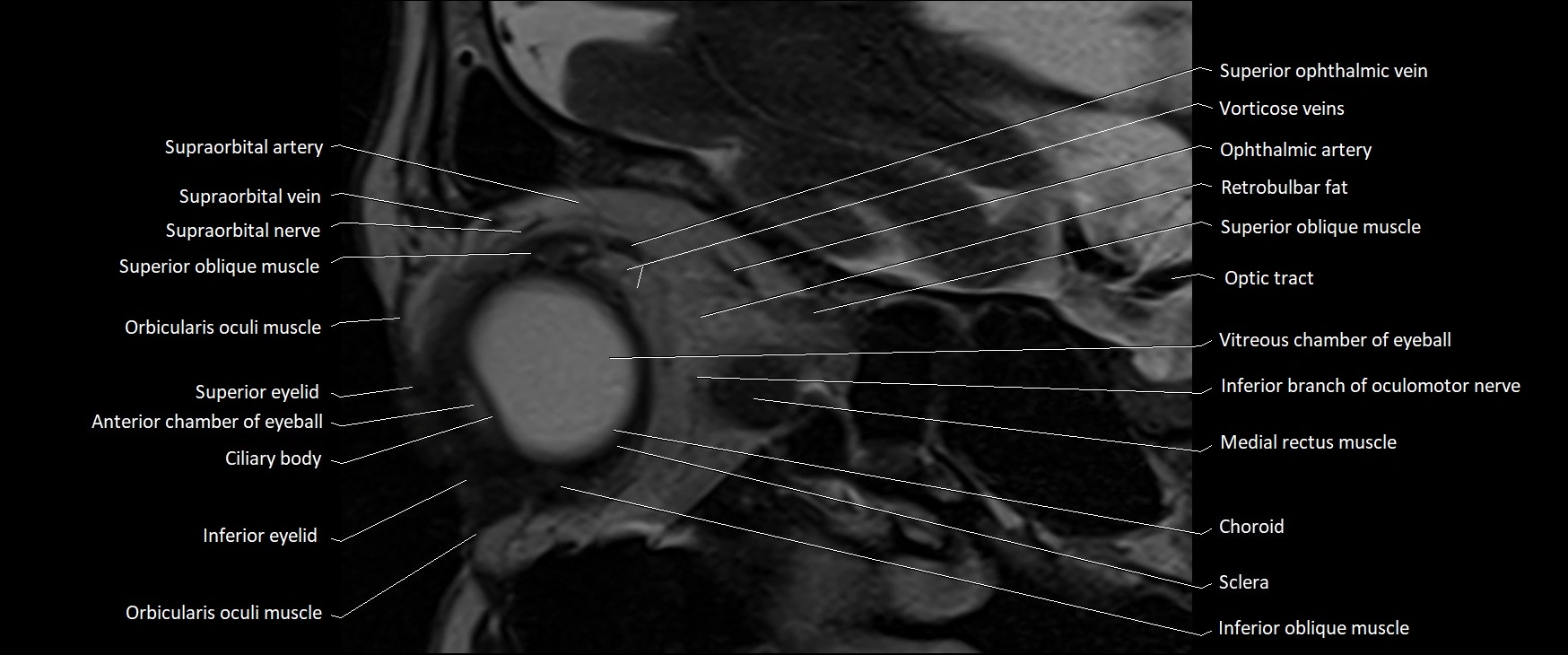 MRI Orbit sagittal cross sectional anatomy 3T image 6.webp